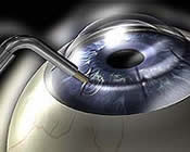 Conductive Keratoplasty